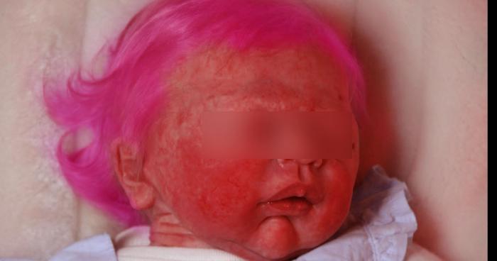 Un bébé brûlé par une coloration rose